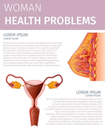 Woman Health Problem. Female Uterus and Breast Highly Detailed View Scheme. Aid of Woman Reproductive System Disorder. Anatomical Vertical Medical Banner with Copy Space. Vector Realistic Illustrationのイラスト素材