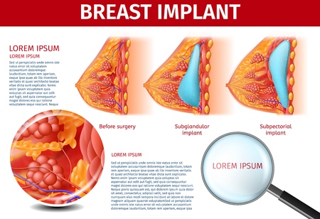 Woman's Breast Before Plastic Surgery, Subglandular and Subpectorial Implants Insertion Method. View on Text Through Magnifier. Anatomical Medical Banner, Vector Realistic Illustration, Copy Space.のイラスト素材