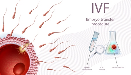 In Vitro Fertilization Embryo Transfer Procedure. IVF Process Chart with Schematic Explanations and Icons. Sperm Preparetion, ICSI Process, Co-Incubation. Realistic Vector Illustration, Medical Bannerのイラスト素材