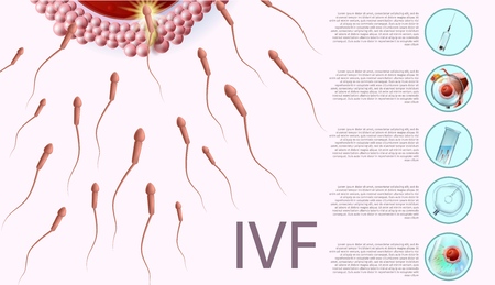 In Vitro Fertilization Informational List, Medical Banner with Copy Space. Fertilization Process, Human Reproductive IVF. Fertility Reproduction of Ovum and Spermatozoon. Vector Realistic Illustrationのイラスト素材