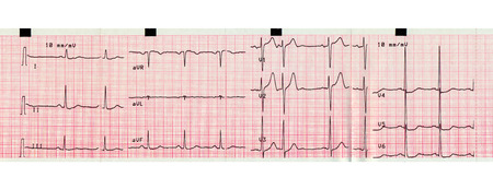 Electrocardiography ECG aka EKG Elektrokardiogramm to measure heartbeatの写真素材