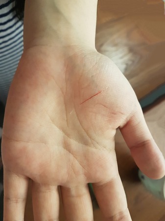 Foreground image of a cut on palm with blur backgroundの写真素材