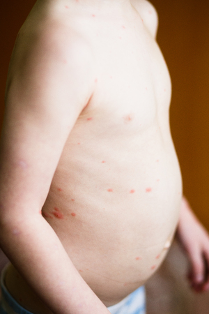 Baby with red spots of chickenpox on babyの写真素材