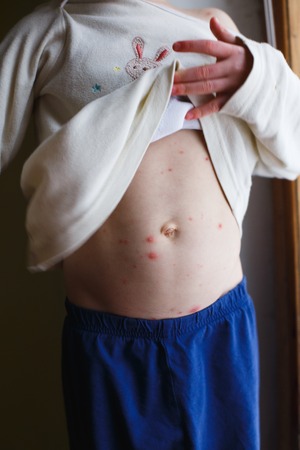 Baby with chicken pox rash. Toddler shows blemishes on his bellyの写真素材