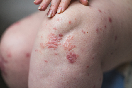 applying an emollient to dry flaky skin as in the treatment of psoriasis, eczema and other dry skin conditionsの写真素材