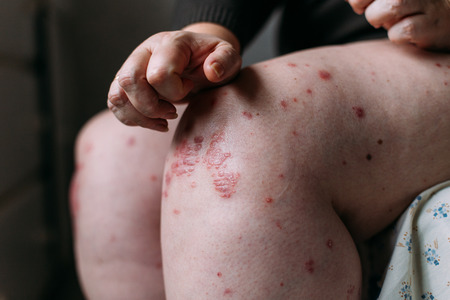 The problem with many people - eczema on hand. Lifestyle background. Woman itchind skin.の写真素材