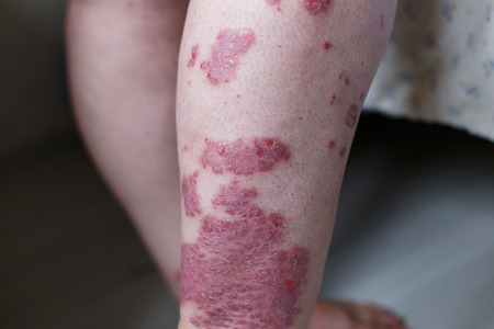 Allergic rash dermatitis eczema skin on leg of patient. Psoriasis and eczema skin with big red spots. Health conceptの写真素材