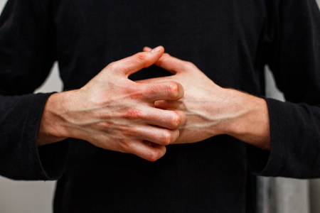 Man scratch oneself, dry flaky skin on hand with psoriasis vulgaris, eczema and other skin conditions like fungus, plaque, rash and patches. Autoimmune genetic disease.の写真素材