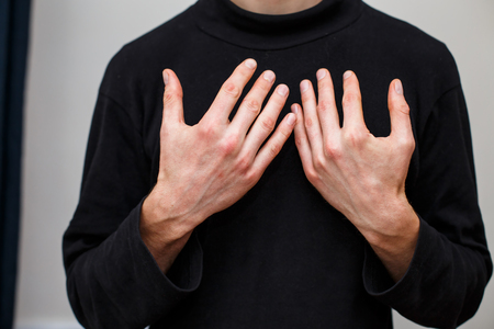 The problem with many people - eczema on hand. Man in black itchind skin.の写真素材