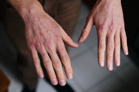 Psoriasis skin. Closeup of rash and scaling on the patient's skin. The concept of chronic disease treatment. Dermatological problems. Hard, horny and cracked skin in man's hands.の写真素材