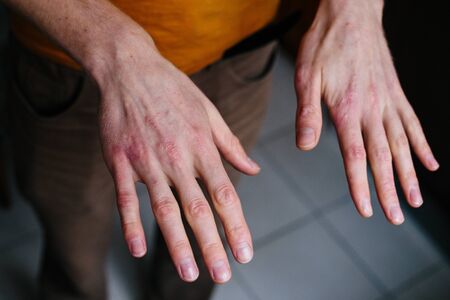 high angle view of hands suffering the dryness on the skin and deep cracks on knuckles.の写真素材