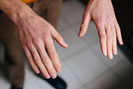 Psoriasis skin. Closeup of rash and scaling on the patient's skin. The concept of chronic disease...