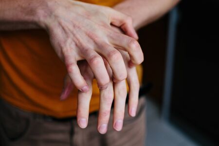 Man scratch oneself, dry flaky skin on hand with psoriasis vulgaris, eczema and other skin conditions like fungus, plaque, rash and patches.の写真素材