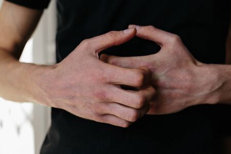 Cracked, flaky skin on the hands. Dermatological problems of psoriasis. Hard, horny and cracked skin...