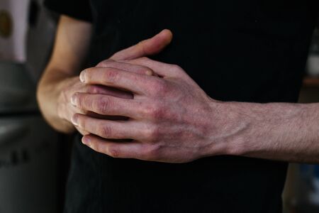 Cracked, flaky skin on the hands. Dermatological problems of psoriasis. Hard, horny and cracked skin...