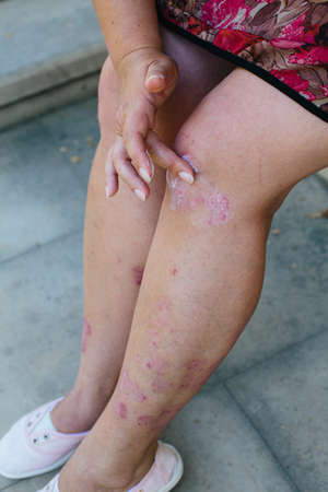 applying an emollient to dry flaky skin as in the treatment of psoriasis, eczema and other dry skin conditionsの写真素材