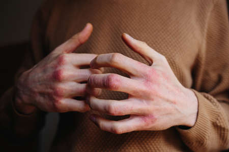 Allergic rash dermatitis eczema skin of patient. Man itchind skin with psoriasisの写真素材