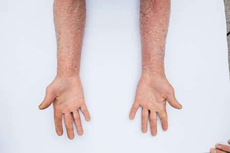 Caucasian Hands With Psoriasis vulgaris Or Eczema Sickness - Hand Skin Disease Concept - Close Up Shot on white backgroundの写真素材