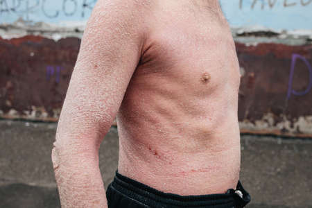 A man with psoriasis on his back and neck. Scratch with his hand. Psoriasis vulgaris skin problem