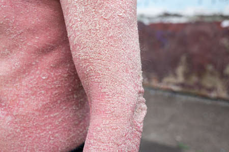 A man with psoriasis on his back and neck. Scratch with his hand. Psoriasis vulgaris skin problem