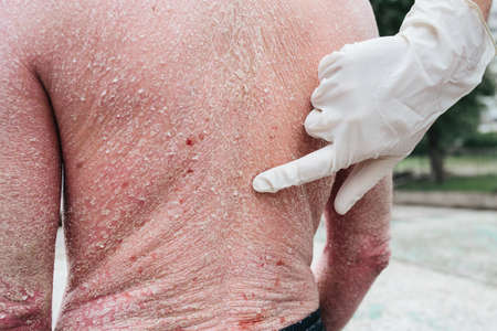 Doctor examining patient with psoriasis on back, closeup. Outdoorの写真素材