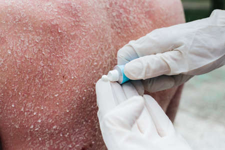 A dermatologist wearing gloves examines the skin of a sick patient. Examination and diagnosis of skin diseases-allergies, psoriasis, eczema, dermatitis. The doctor applies the cream to the skinの写真素材