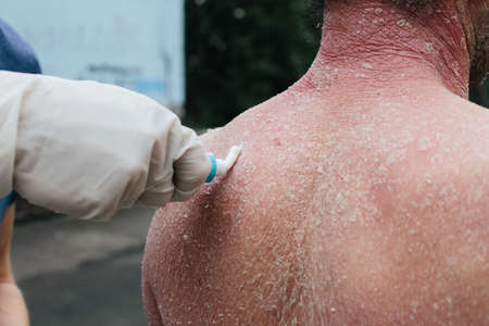 A dermatologist wearing gloves examines the skin of a sick patient. Examination and diagnosis of skin diseases-allergies, psoriasis, eczema, dermatitis. The doctor applies the cream to the skinの写真素材