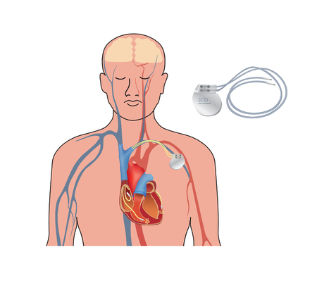 Vector of Heart pacemaker. Human heart - ID:1-103271783 - Royalty Free ...