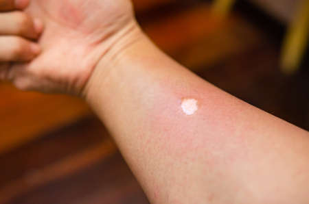Wounds caused by accidental burns to the skin Soft focusの写真素材