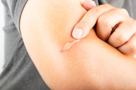 Arm scald Wounds caused by scalding hot water Wound inflammationの写真素材