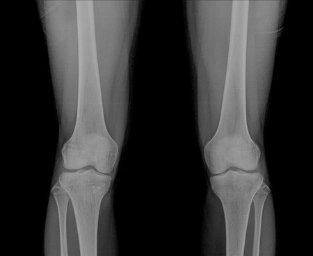 x-ray 2 knee joint ( Knee joint Antero-posterior )on black backgroundの写真素材