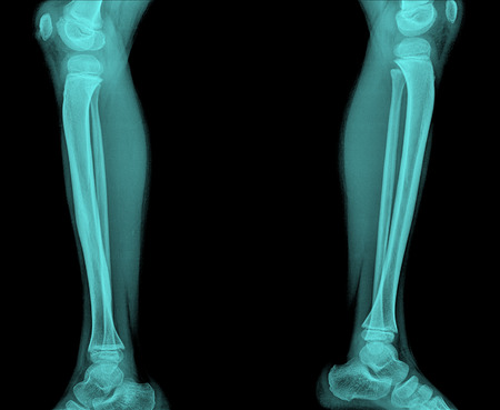 X-ray of knees of both legs