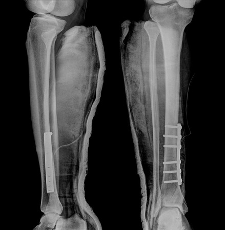 broken leg x-rays imageの写真素材