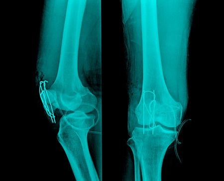 x-ray image of painful knee jointの写真素材