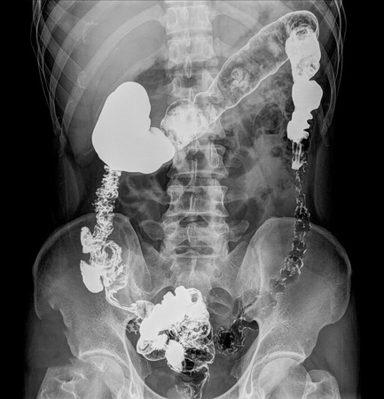Colon / Large Instestine - Male anatomy of human organs - x-ray viewの写真素材