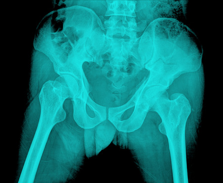 X-ray of the pelvis and spinal column.の写真素材