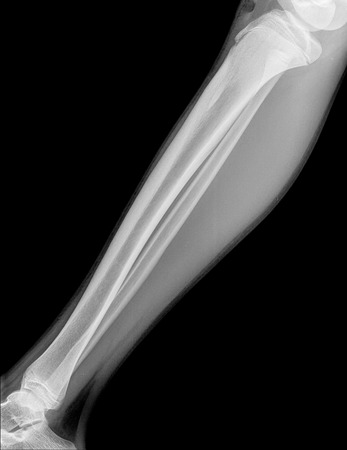 X-ray image of leg