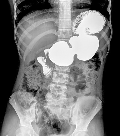 x-ray of intestinal abdominal