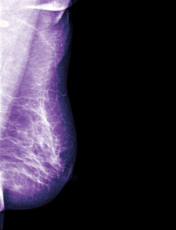 x-ray mammogramの写真素材