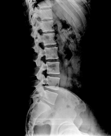 X-ray lumbo-sacral spine and pelvis of asian adult people ,side view