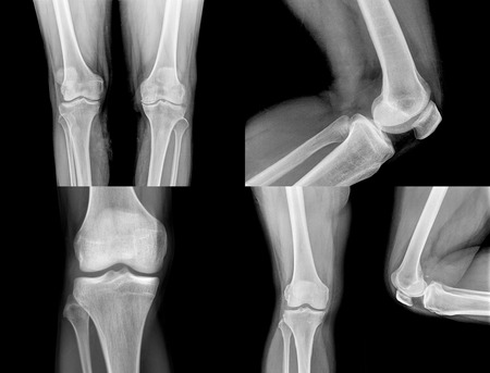 collection of  xray of normal a human knee isolated