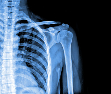 x-rays image of the painful or injury shoulder joint ,shoulder dislocation