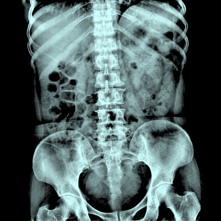 xray showed kidney stonesの写真素材