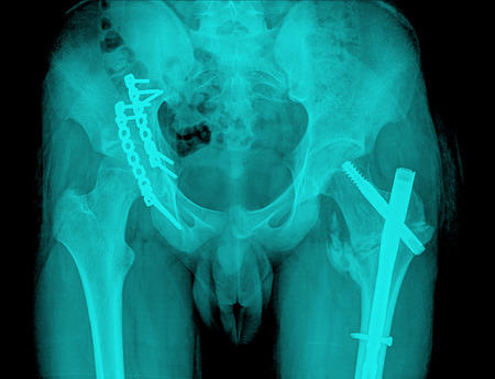 hip replacement surgery, good outcomeの写真素材