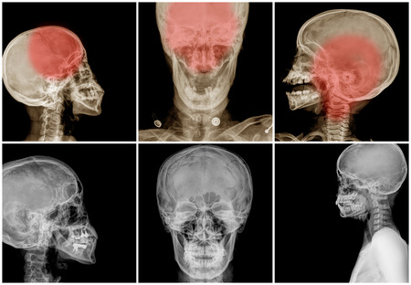 Collection of asian's skull xrayの写真素材