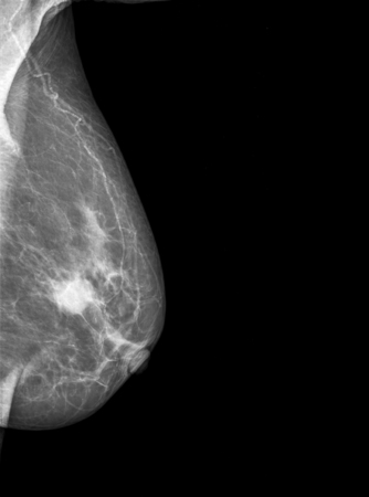 mammography breast scan X-ray imageの写真素材