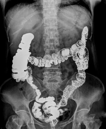 picture of intestinal abdominal xray