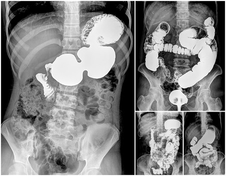 Collection of Intestine and spine x-rayの写真素材