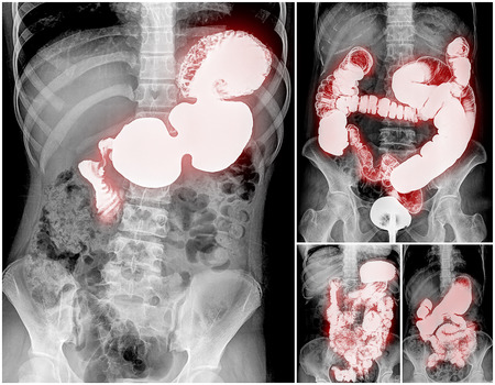Collection of Intestine and spine x-rayの写真素材