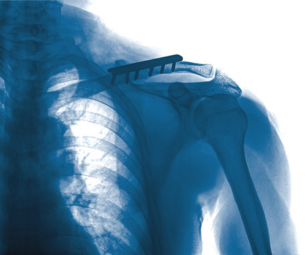 rengs snapshot of the shoulder joint with a bolt , xray